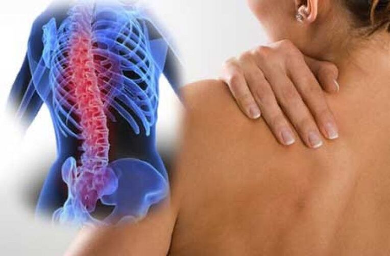 Bei Osteochondrose können Schmerzen in entfernte Körperregionen ausstrahlen
