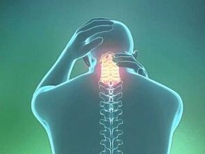 Ein Symptom der zervikalen Osteochondrose sind Kopfschmerzen