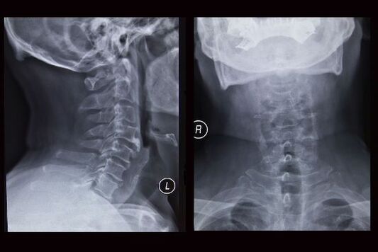 Röntgenbild der Halswirbelsäule (der Patient hat Osteochondrose)
