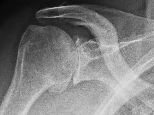 Röntgenaufnahme eines von Arthrose betroffenen Schultergelenks