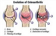 Arthrosestadien