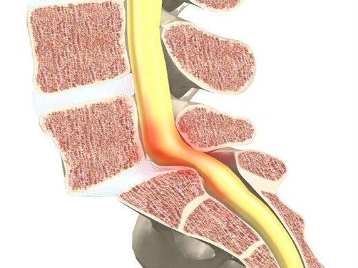 Blutmotorsegment für Osteochondrose