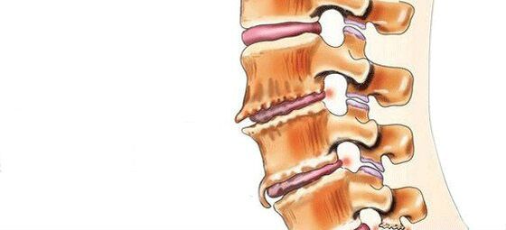 Spondylose - Zerstörung von Zwischenwirbelgelenken