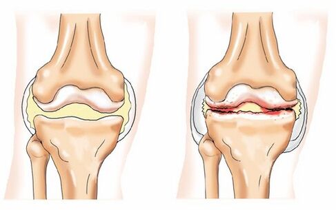Gesunde Gelenk und Arthrose