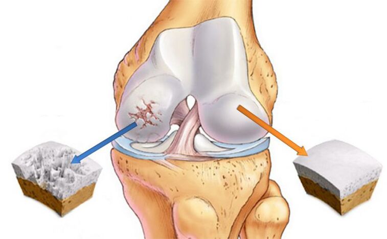 Verformung Arthrose