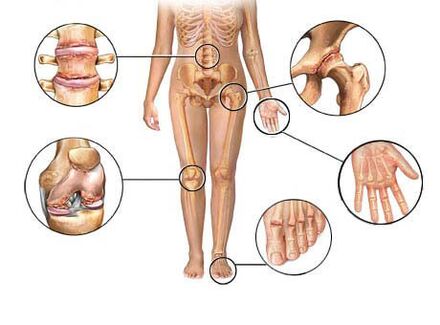 Arthrose betrifft verschiedene Gelenke