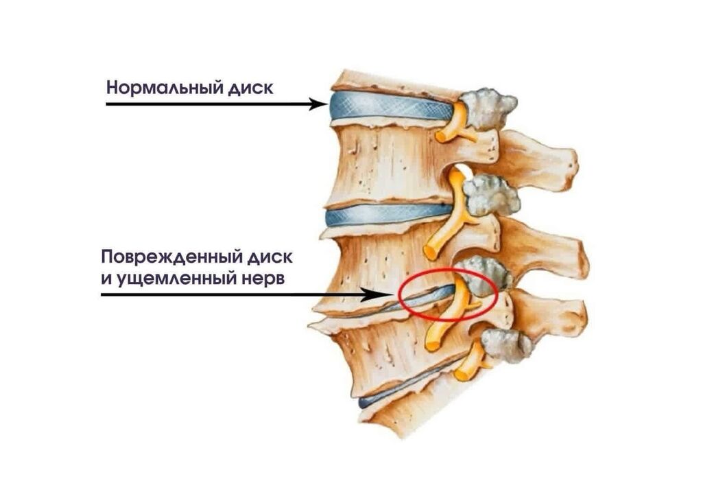 Symptome einer zervikalen Osteochondrose