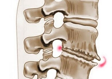 Schädigung der Wirbel bei thorakaler Osteochondrose