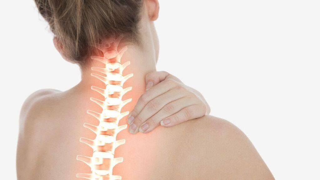 Bei einer Osteochondrose der Halswirbelsäule kann sich ein radikuläres Syndrom entwickeln