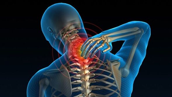 Schmerzen beim Drehen des Halses können auf ein vertebrales zervikales Osteochondrose-Syndrom hinweisen