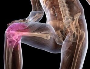 Schmerzen im Knie mit Arthrose