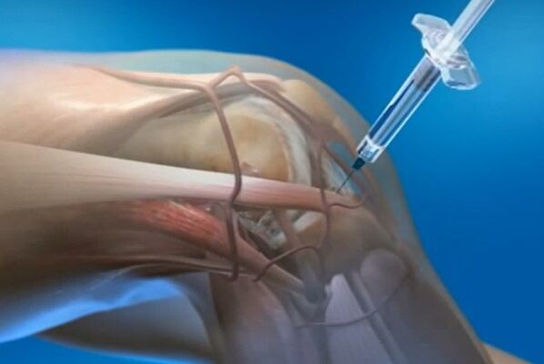 intraartikuläre Injektionen bei Arthrose des Kniegelenks