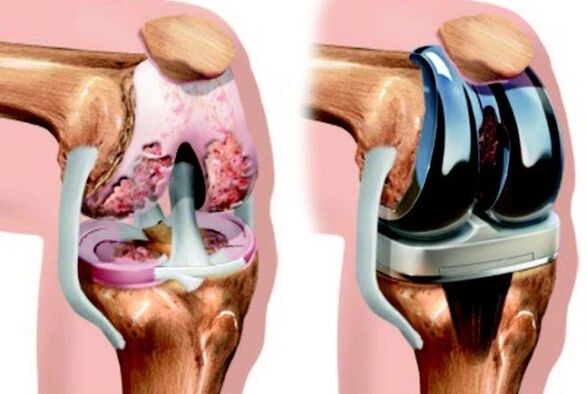 vor und nach Arthrose des Kniegelenks bei Arthrose